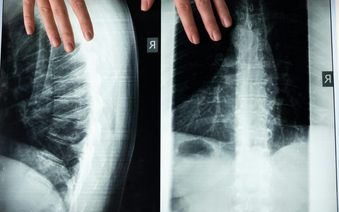 Spinal Discs and Hydrogels: Groundbreaking Research in Regenerative Medicine